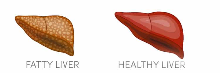 Liver Disease